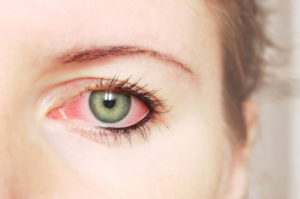 Extreme close up of an irritated, green eye.