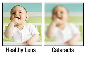 Healthy vs. Eye Affected by Cataracts