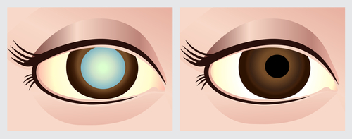 Graphic comparison of two eyes, one with a cataract and one without. The eye on the left has a milky film over its lens, while the eye on the right is clear.