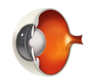 Diagram of an eye with a cataract.