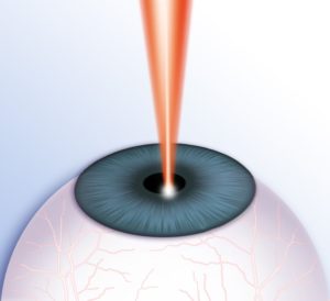 Diagram of Lasers entering an eye.