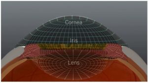 3-D imaging of the Eye affected by cataracts