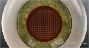 Cataract Removal Diagram