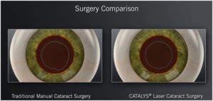 Cataract Surgery Comparison, Traditional Vs Laser