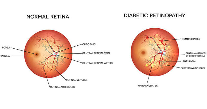 Diabetic Retinopathy 