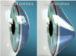 Normal Cornea vs Keratoconus