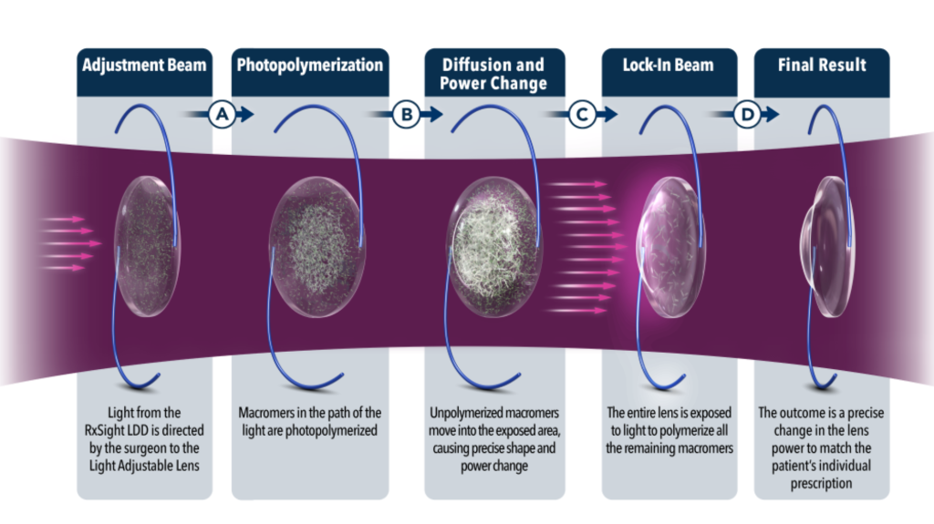 Light Adjustable Lens