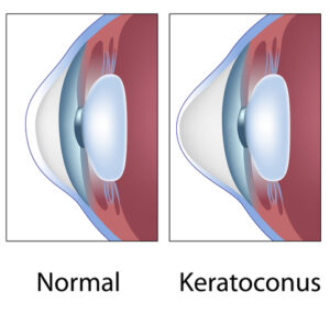 Normal vs. Keratoconus